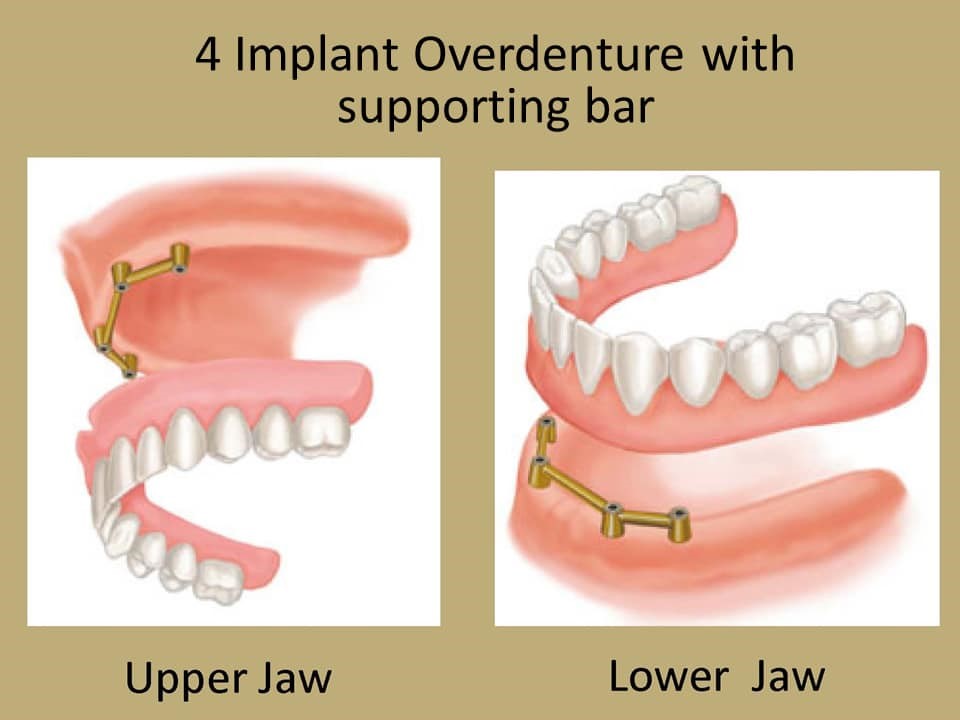 Why I Have Dentures Conroe TX 77303